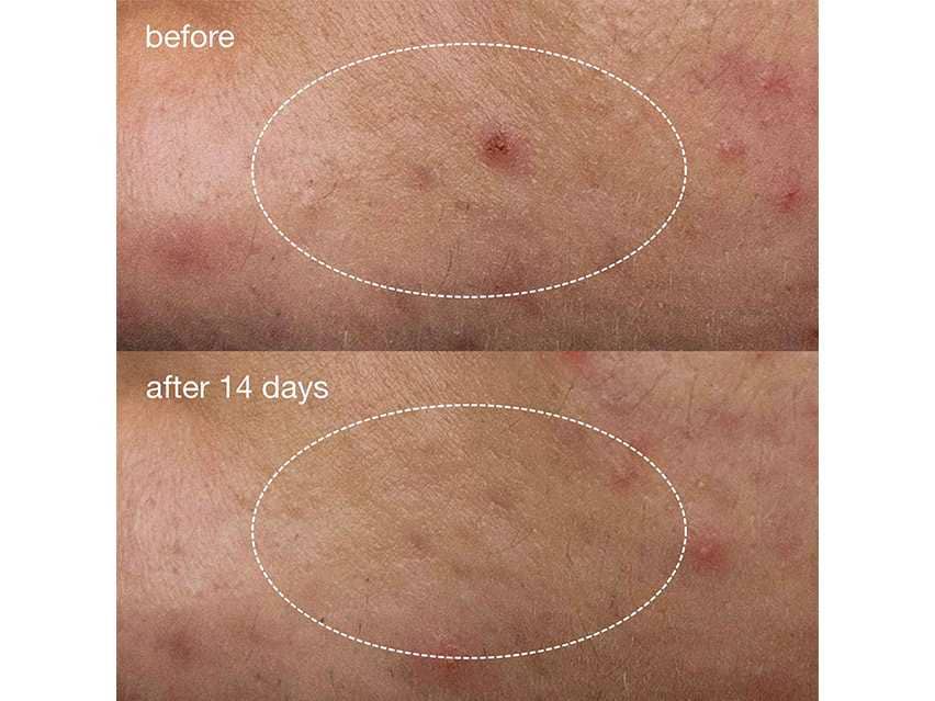 Dermalogica Deep Acne Liquid Patch