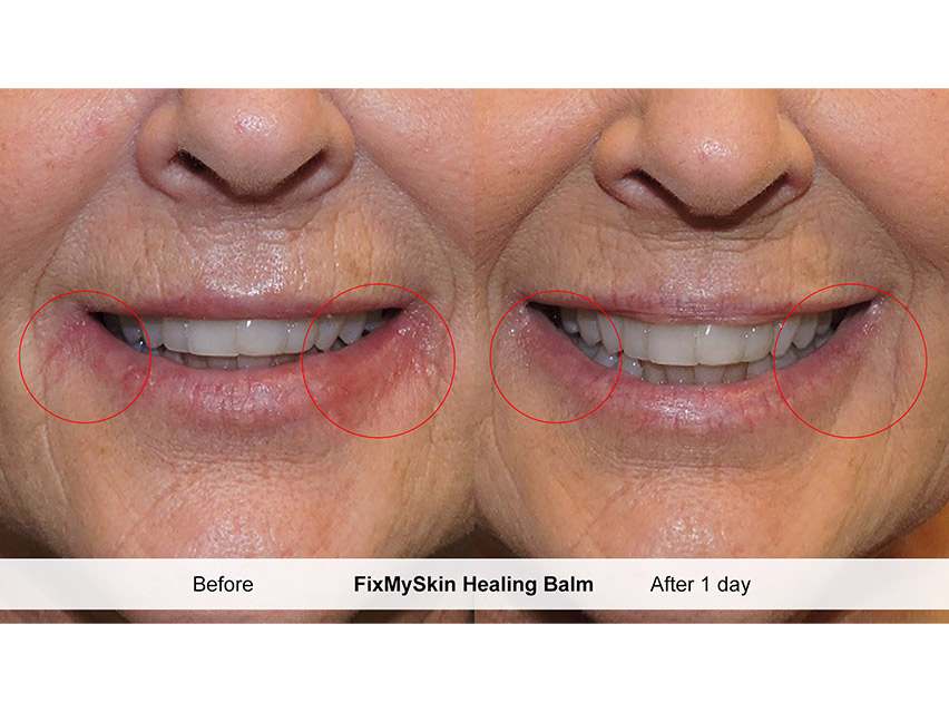 FixMySkin 1% Hydrocortisone Healing Lip Balm – Vanilla