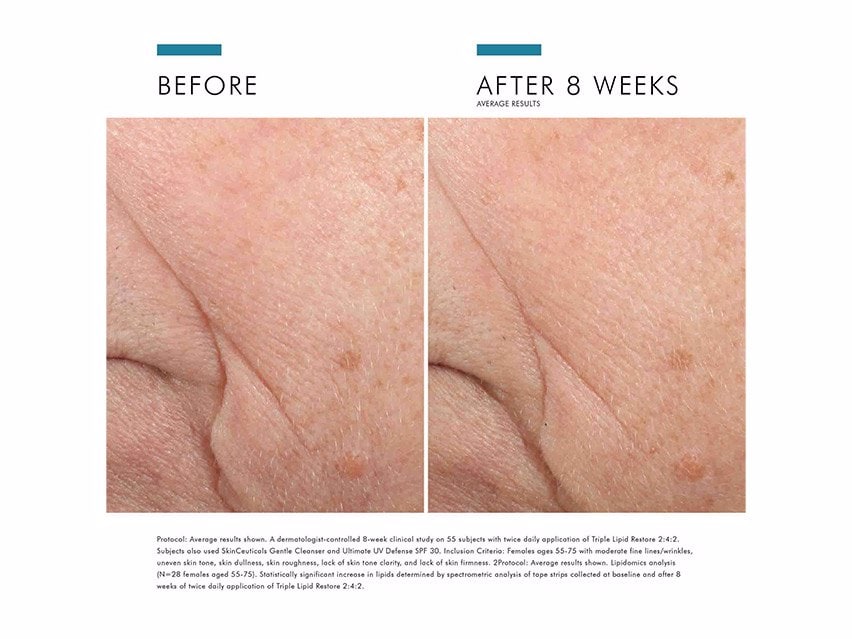SkinCeuticals Triple Lipid Restore 2:4:2 Anti-Aging Cream before and after photos
