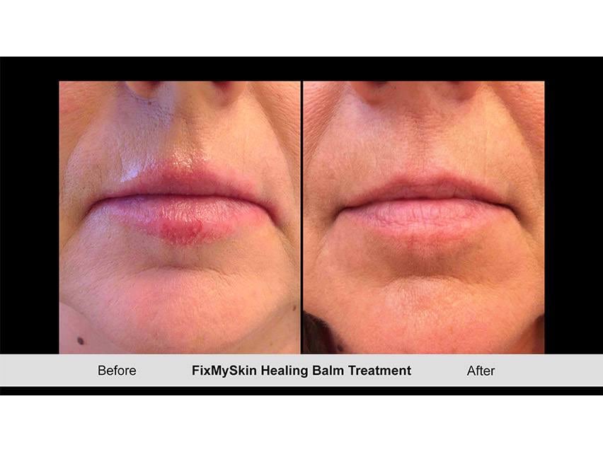 FixMySkin 1% Hydrocortisone Healing Lip Balm – Unflavored