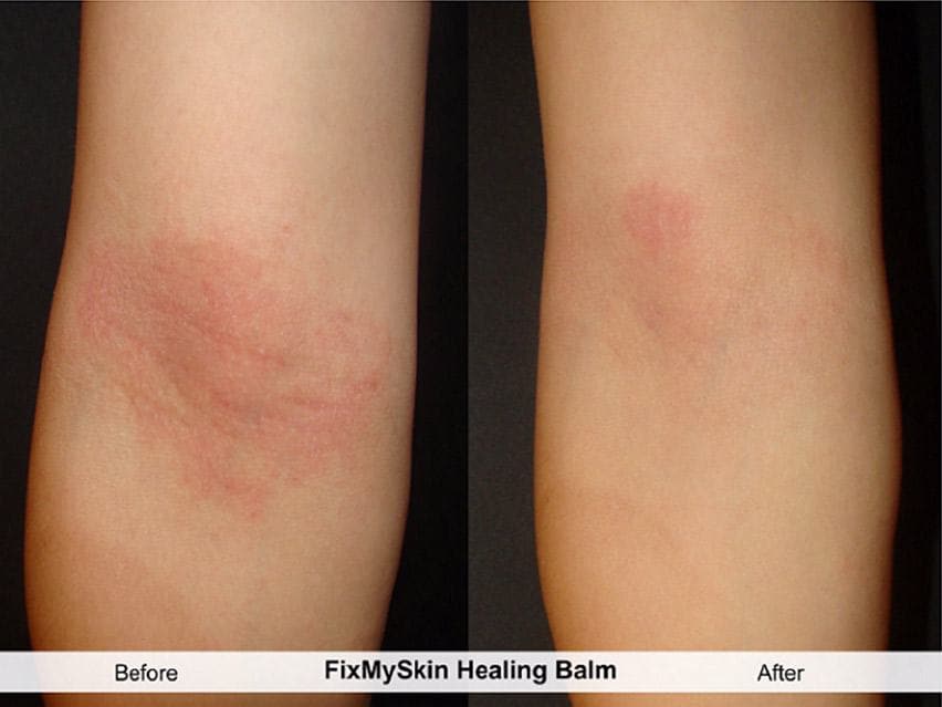 FixMySkin 1% Hydrocortisone Healing Body Balm – Fragrance-Free