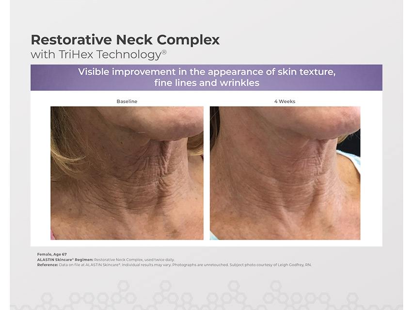 ALASTIN Skincare Restorative Neck Complex with TriHex Technology