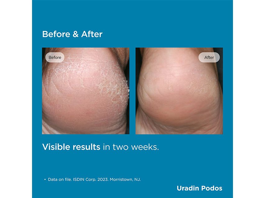 ISDIN Uradin Podos Moisturizing Dry Feet Gel-Oil with 10% Urea