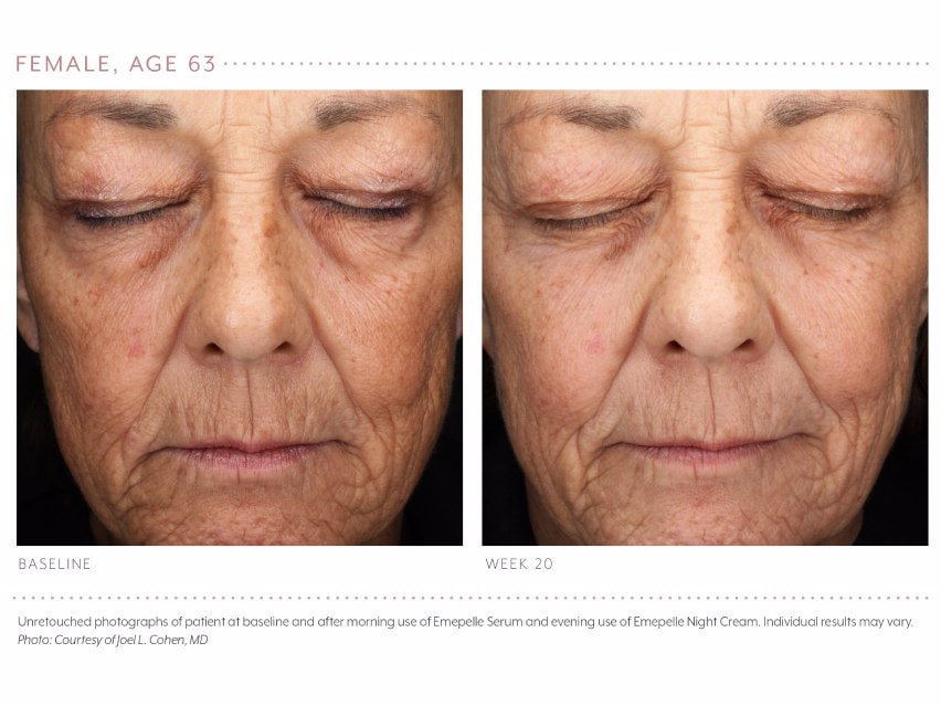 Emepelle Serum