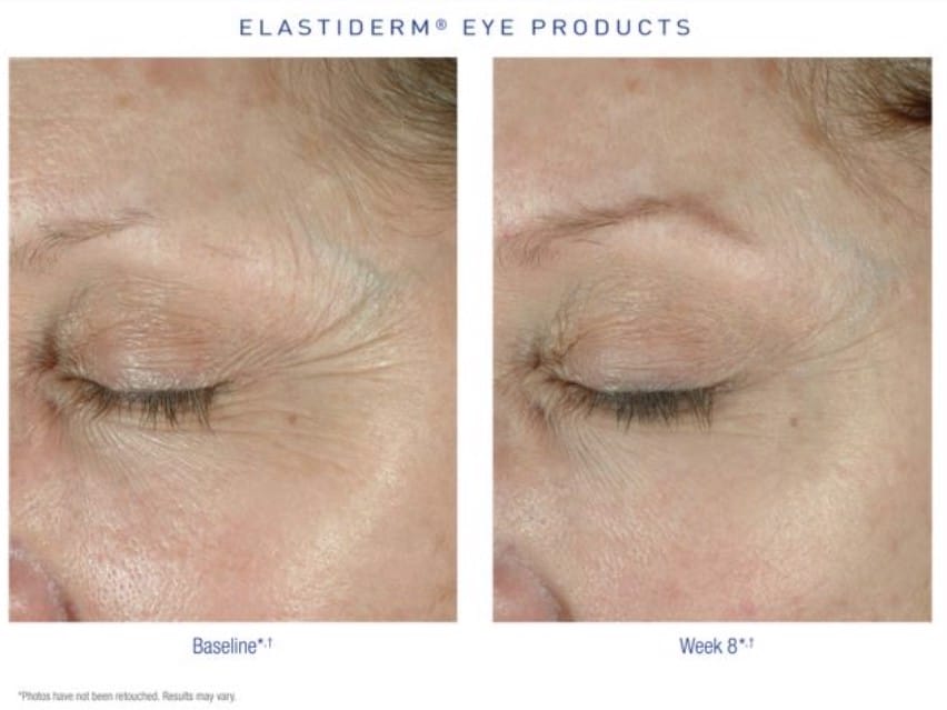 Obagi ELASTIderm Eye Cream Before and After results of one person