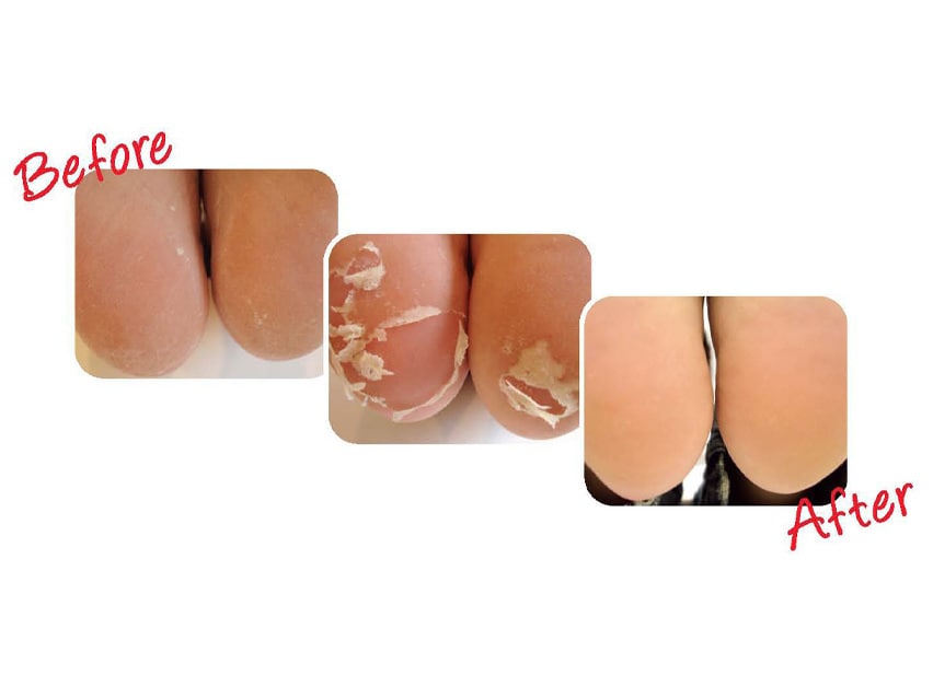 Baby Foot Exfoliation Foot Peel