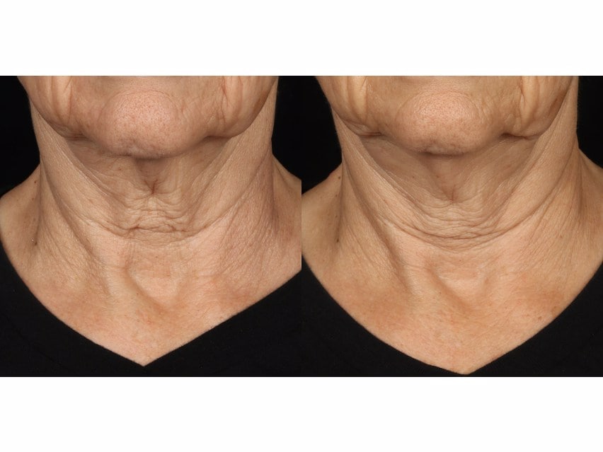Epionce Intensive Nourishing Cream before and after treatment