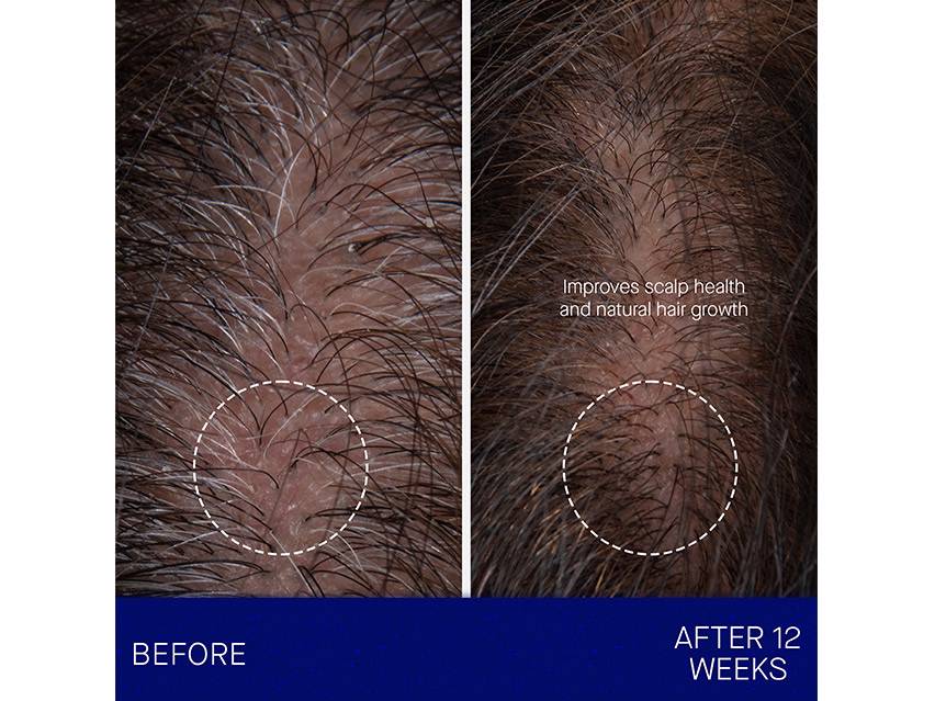 Augustinus Bader The Scalp Treatment